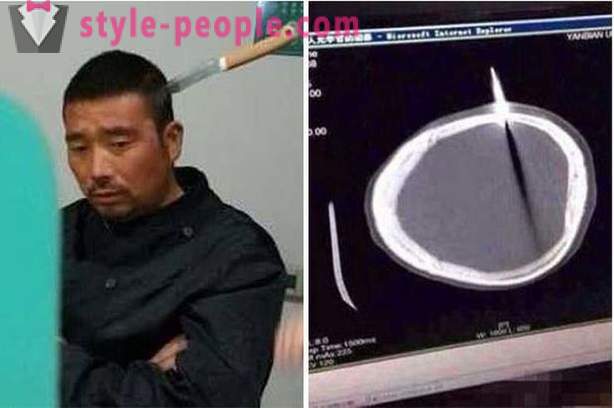 Egy kínai férfi késsel a fejében ment az orvoshoz