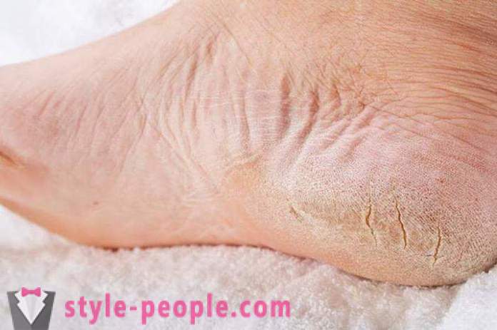 A száraz bőr a lábad: okai