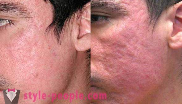 Hogyan lehet eltávolítani a bőrirritáció az arcon
