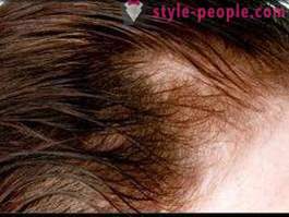 Miért haj hullik ki a szülés után? Mit kell tennie ahhoz, hogy a haj vastag?