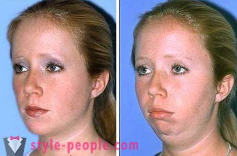 Hogyan lehet eltávolítani az arc műtét nélkül